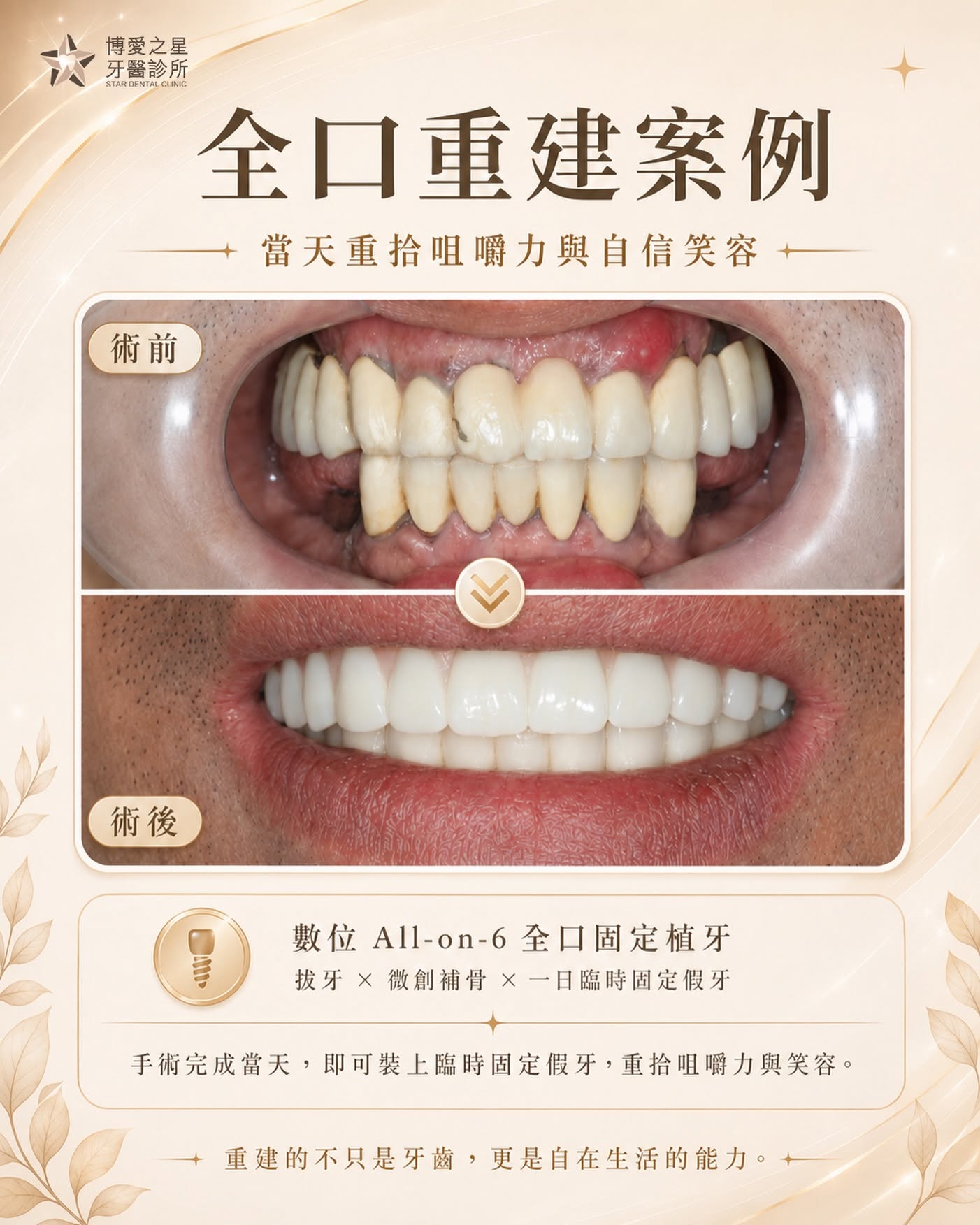 鼓山植牙推薦：數位 All-on-6 全口重建案例術前術後對比