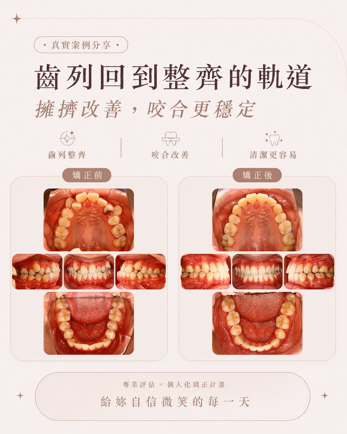 矯正前後齒列對比：擁擠改善，咬合更穩定