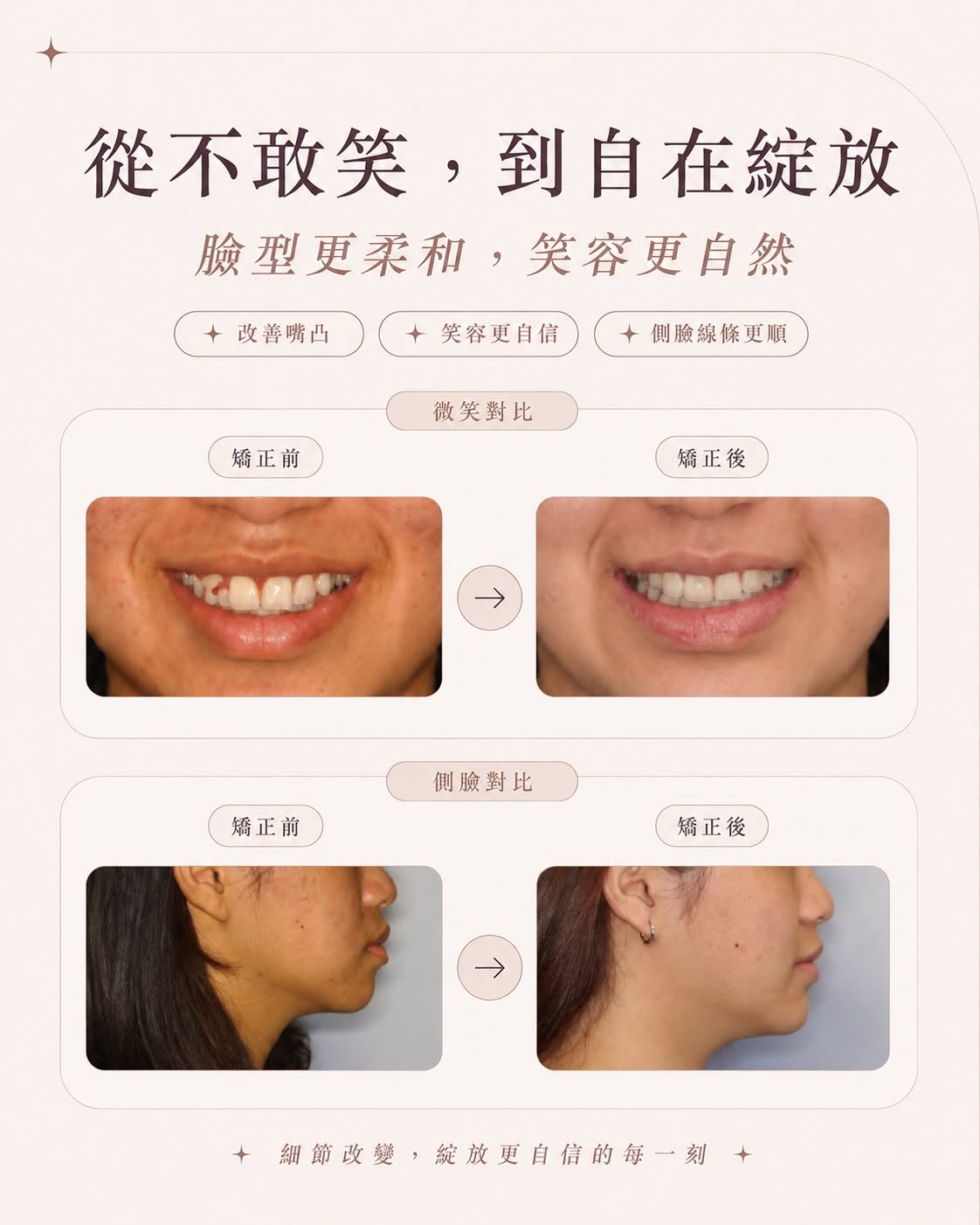 矯正前後正面與側臉對比：臉型更柔和，笑容更自然